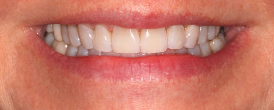 After photograph, Invisalign case 26 of 33, published by Berry Farms Dental
