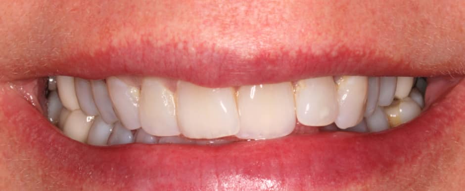 Before photograph, Invisalign case 26 of 33, published by Berry Farms Dental