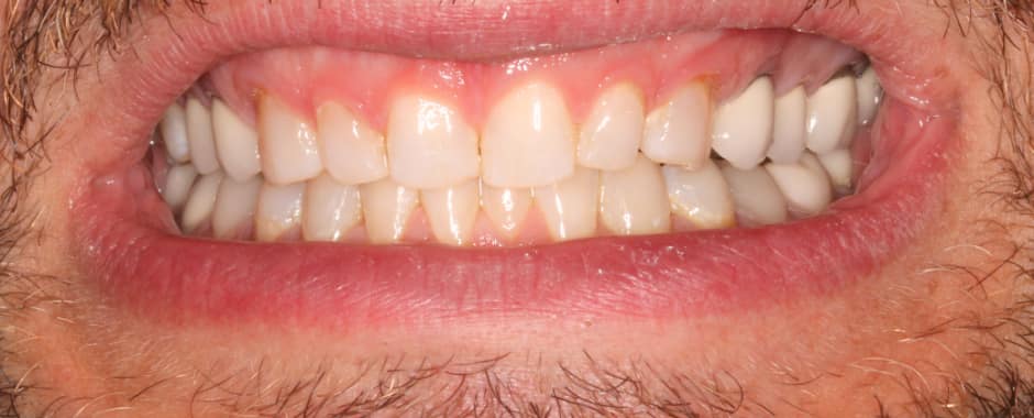 After photograph, Invisalign case 27 of 33, published by Berry Farms Dental