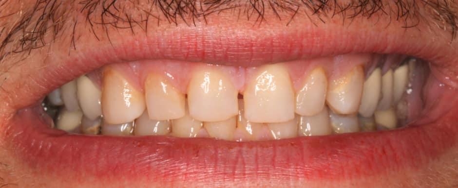 Before photograph, Invisalign case 27 of 33, published by Berry Farms Dental