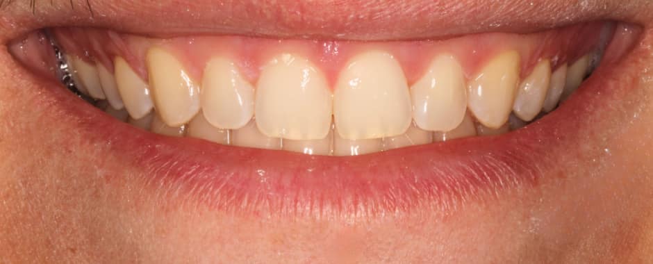After photograph, Invisalign case 28 of 33, published by Berry Farms Dental