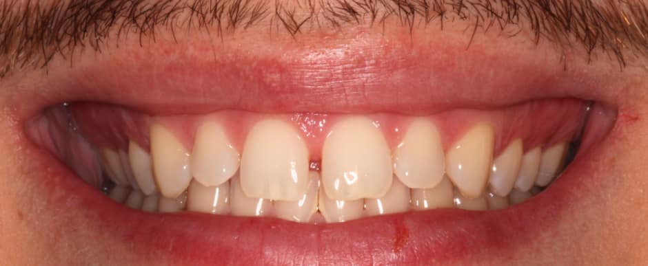 Before photograph, Invisalign case 28 of 33, published by Berry Farms Dental