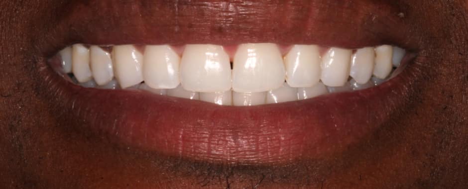 After photograph, Invisalign case 29 of 33, published by Berry Farms Dental