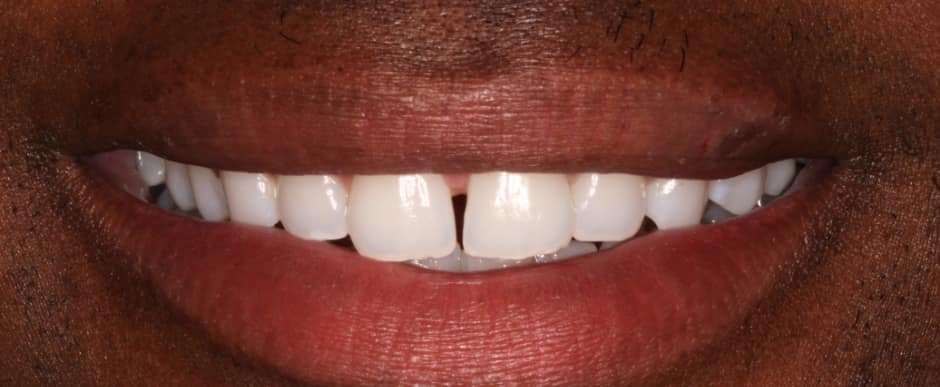 Before photograph, Invisalign case 29 of 33, published by Berry Farms Dental