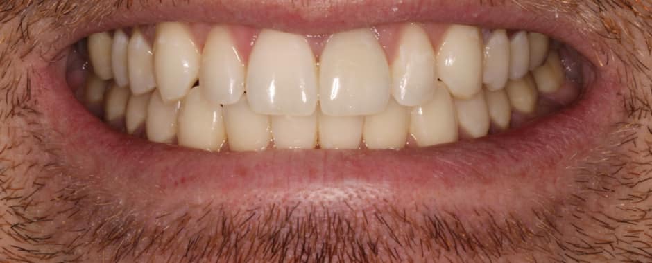 After photograph, Invisalign case 30 of 33, published by Berry Farms Dental