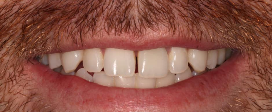 Before photograph, Invisalign case 30 of 33, published by Berry Farms Dental