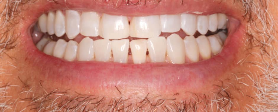 After photograph, Whitening case 31 of 33, published by Berry Farms Dental