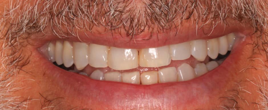 Before photograph, Whitening case 31 of 33, published by Berry Farms Dental