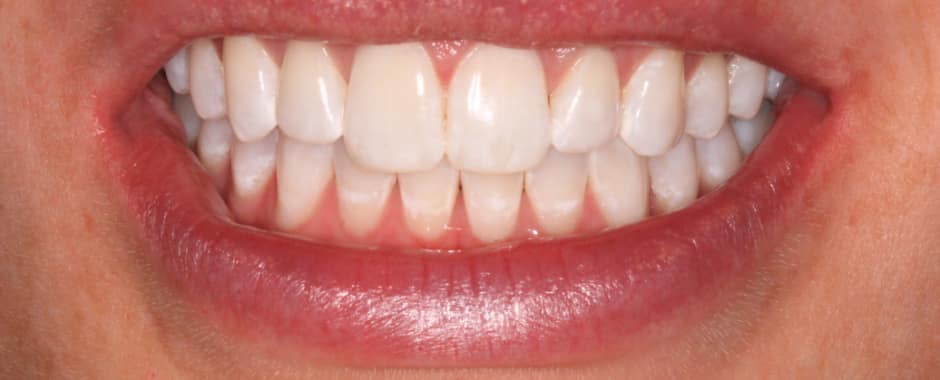 After photograph, Whitening case 32 of 33, published by Berry Farms Dental