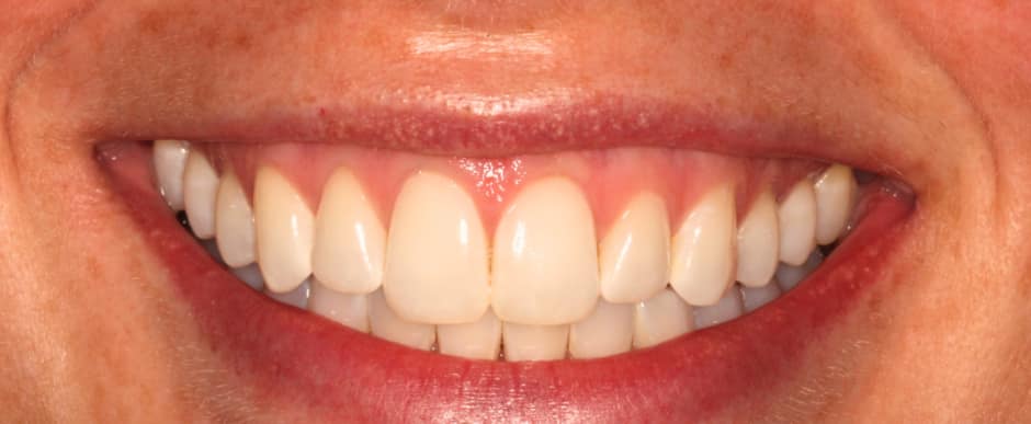 Before photograph, Whitening case 32 of 33, published by Berry Farms Dental