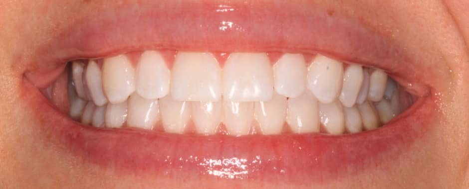After photograph, Whitening case 33 of 33, published by Berry Farms Dental