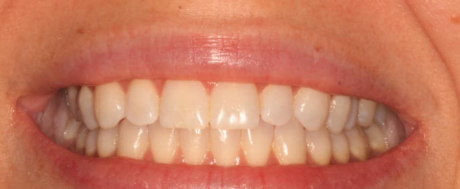 Before photograph, Whitening case 33 of 33, published by Berry Farms Dental